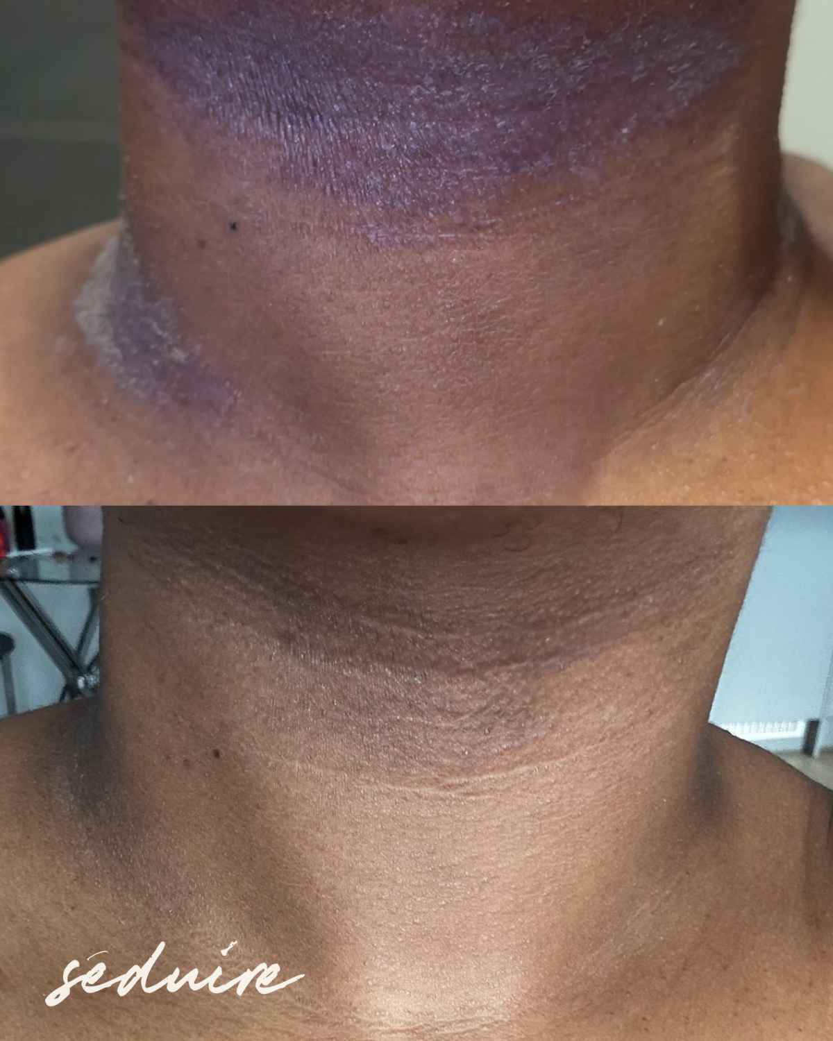 a before and after photo of healed eczema patch after using our hydrating body lotion for dry skin conditions