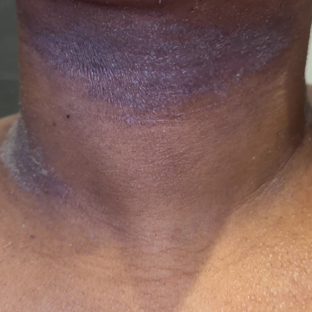 a photo of an eczema flare up on the neck with dry itchy flaky skin and hyperpignentation
