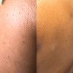 before and after back acne results from using a sugar body scrub with licorice root extract and salicylic acid for exfoliation
