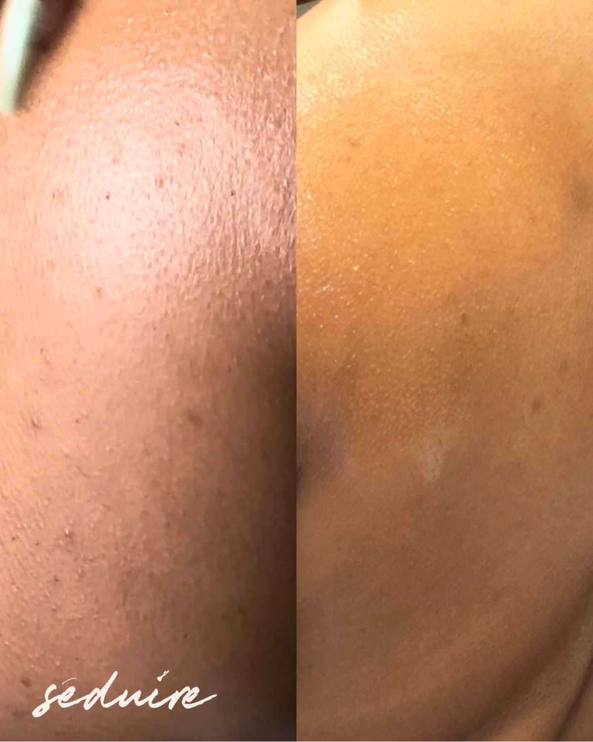 before and after back acne results from using a sugar body scrub with licorice root extract and salicylic acid for exfoliation