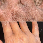 before and after hand eczema transformation on black skin by using secret obsession body whip emulsifed body butter for dry skin and eczema
