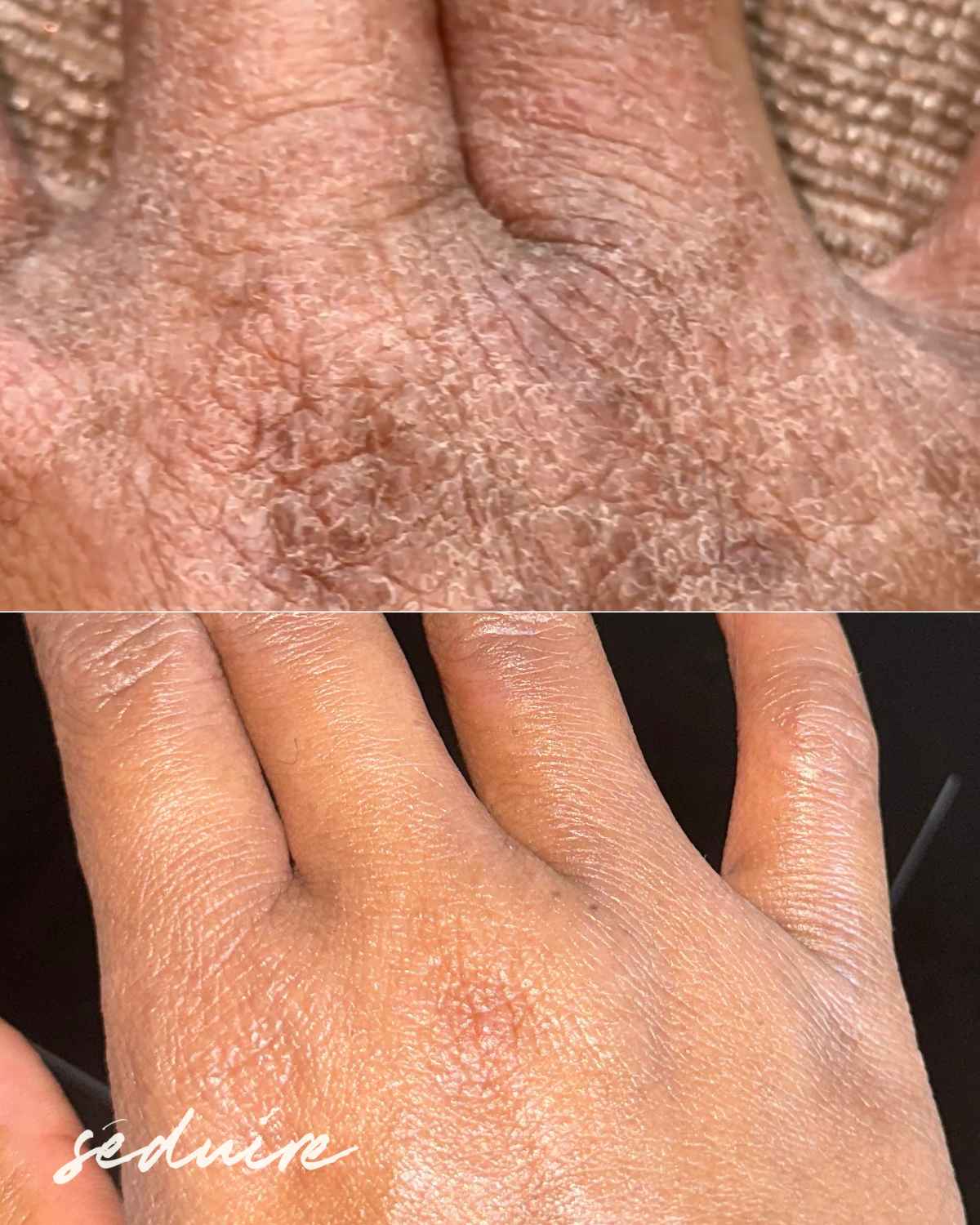 before and after hand eczema transformation on black skin by using secret obsession body whip emulsifed body butter for dry skin and eczema