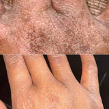 before and after hand eczema transformation on black skin by using secret obsession body whip emulsifed body butter for dry skin and eczema