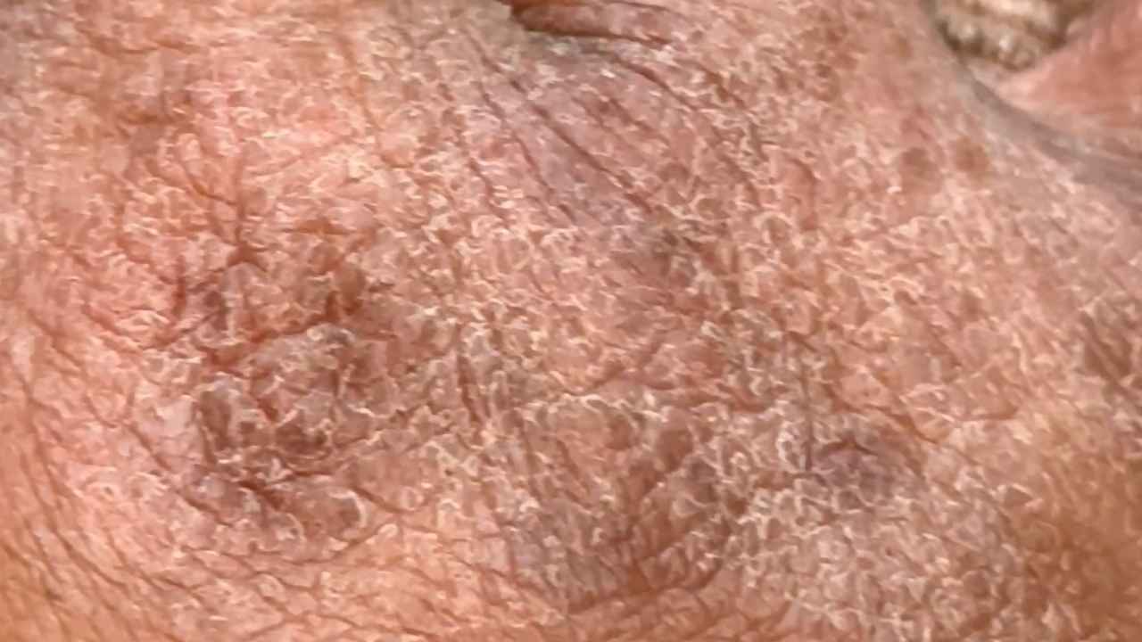 radiant Relief: How to Manage Eczema and Keep Your Glow